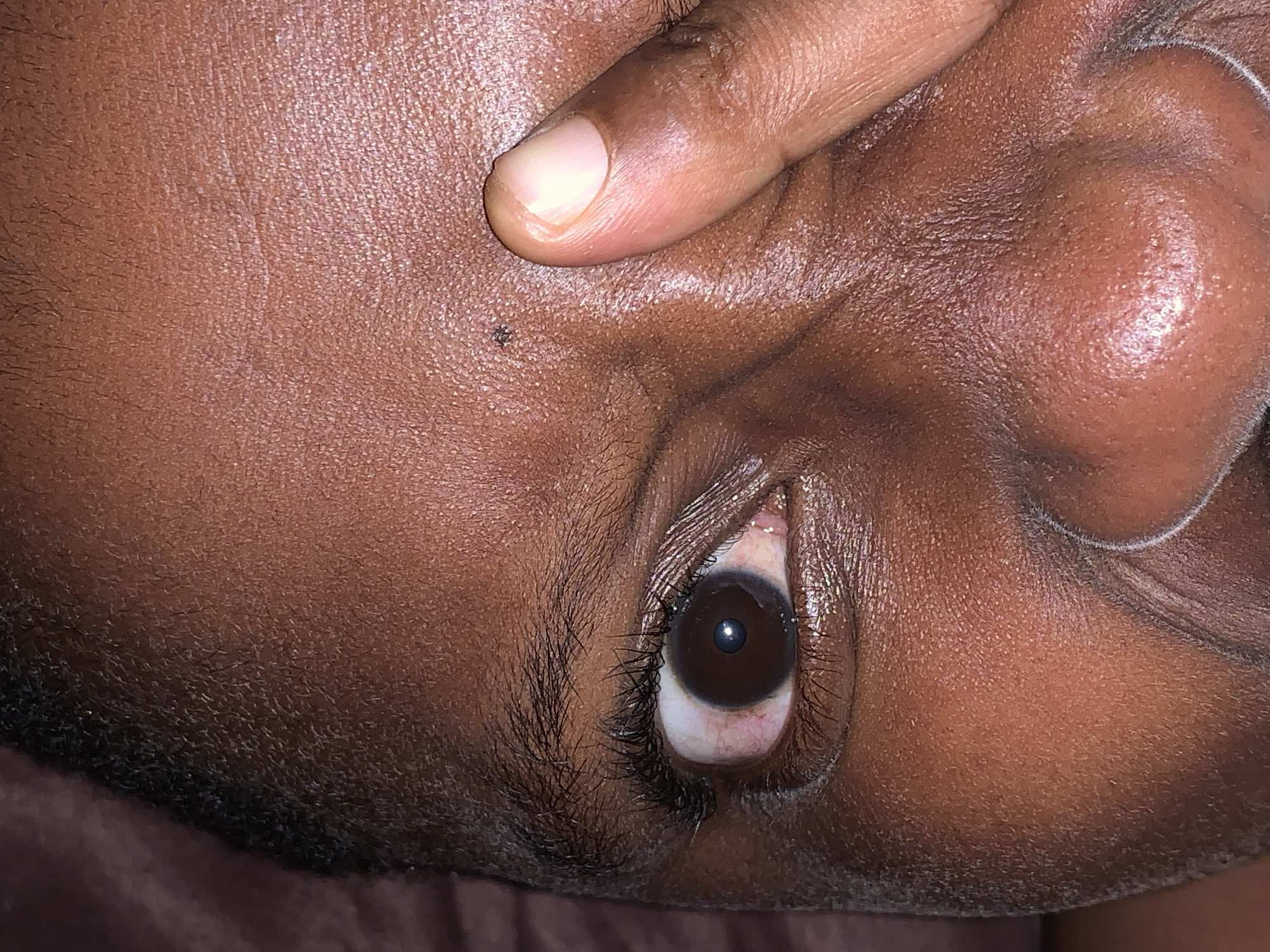 A close-up, upward-angled photograph shows a person's face, dominated by a single visible eye and a finger near the forehead. The person has dark brown skin. The eye is open, with a dark brown iris and a slightly bloodshot sclera. Eyelashes are visible on the upper and lower lids. A fingertip presses gently near the forehead. A small, dark spot is visible on the forehead near the fingertip. The subject’s nose is partially visible on the right side of the frame. The background is blurry and indistinct. The location, Ikorodu, Nigeria, is not discernible from the image.