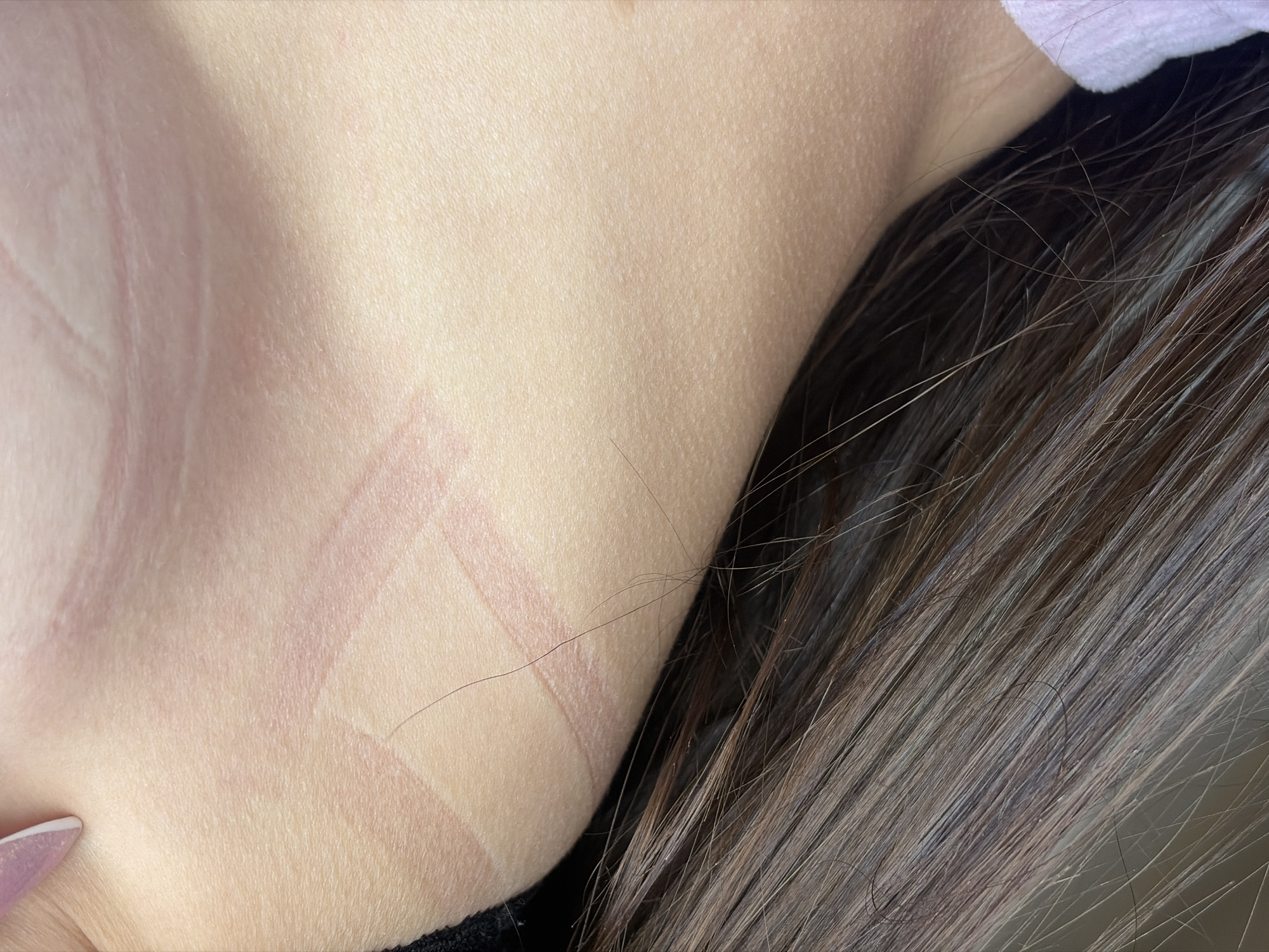 A close-up photograph depicts the skin of a person's neck and chest, marked with a pattern of reddish impressions resembling the imprint of a strap. The skin is fair, smooth, and shows natural variations in tone. The lines of the strap marks are distinct, suggesting recent pressure or contact. Adjacent to the skin, a portion of long, brown hair is visible, its strands catching the light. In the top right corner, a glimpse of lilac fabric is present. The overall scene is presented in sharp focus, emphasizing the texture of the skin and hair.