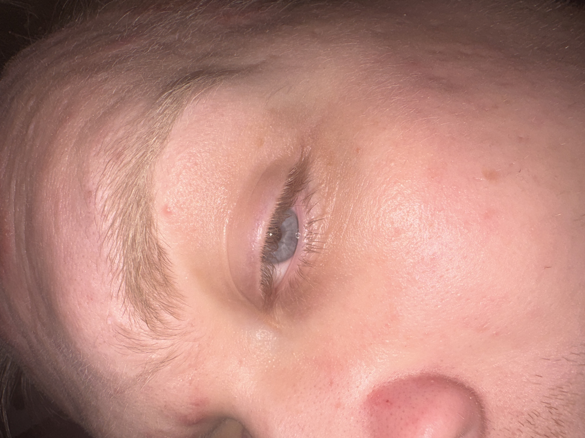 The image is a close-up, poorly lit photograph of a person's face, focusing on the left eye, eyebrow, and part of the forehead and cheek. The individual appears to have light-colored skin and blonde eyebrows and eyelashes. The left eye is open, with a light blue iris. There are some red blemishes and pores visible on the skin, particularly around the nose and cheek. The lighting creates shadows and highlights that obscure some details. No specific location in Saratov, Russia, can be identified from the image.