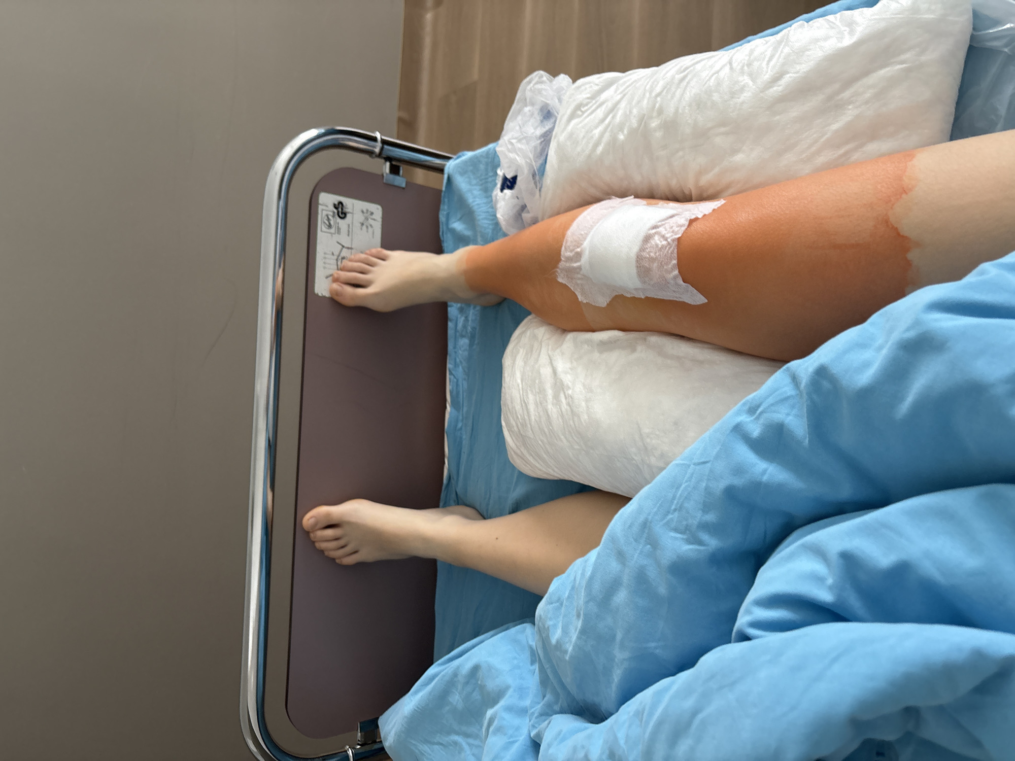 An elevated left leg with a surgical bandage rests on white pillows and a blue hospital blanket on a bed with a chrome and gray side rail. The person's lower right leg extends down under the covers. A hospital wall is visible. This image appears to be taken within a healthcare facility, but the location within Sofia, Bulgaria, cannot be determined.