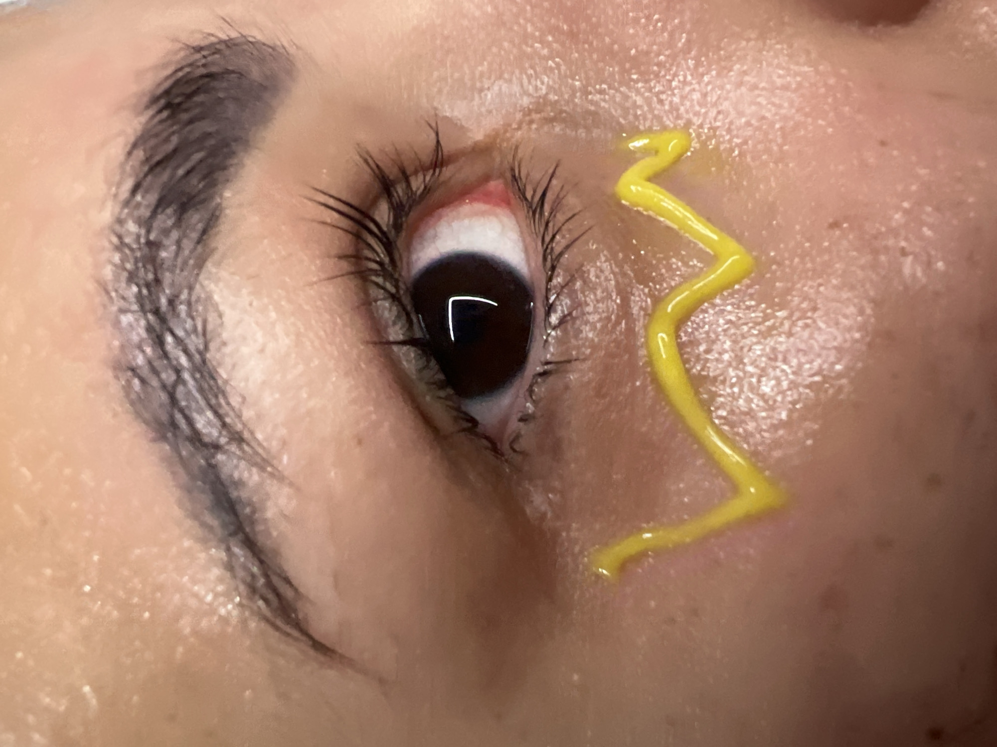 A close-up image depicts a person's eye and eyebrow. The eye is open with dark lashes. A zig-zag line of yellow substance is present on the skin adjacent to the eye. The skin appears textured and somewhat glossy. No information is available to place the subject in the city of Kiryat Bialik, Israel.