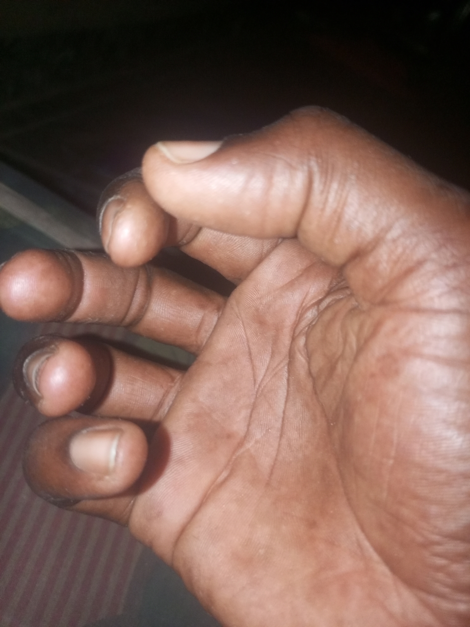 A close-up image depicts a dark-skinned human hand. The fingers are slightly curled inward. The palm shows skin creases and some minor blemishes. The background is dark and indistinct. The location and city are unknown.