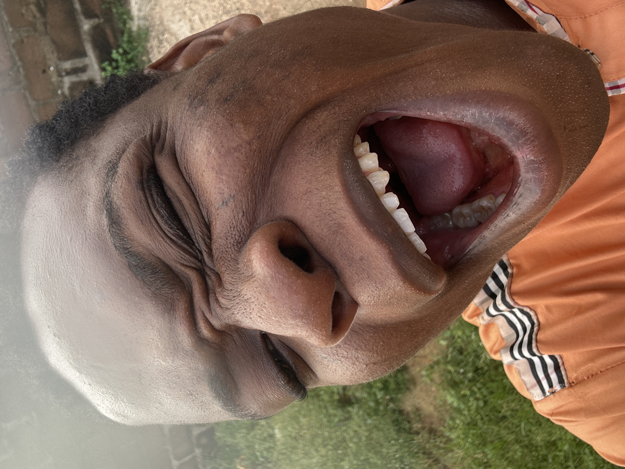 A close-up portrait of a person with dark skin is presented diagonally, capturing an intense facial expression. The person's eyes are squeezed tightly shut, causing deep wrinkles to form around the eyes, nose, and forehead. Their mouth is open wide, revealing white teeth and a pink tongue, suggesting a moment of strong emotion such as laughter or shouting. Short, dark, curly hair is visible on the head and around the neck. The person wears an orange collared shirt with a sleeve featuring a striped pattern of black, white, and a lighter orange or tan. The background suggests an outdoor setting during daytime, with patches of green grass and hints of brickwork and foliage. No text is visible.