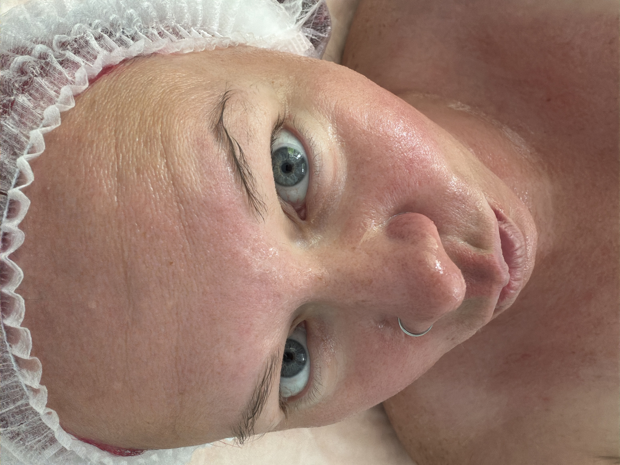 An overhead close-up shot captures a person, likely a woman, lying down with their head turned to the side, wearing a white, ruffled disposable hairnet. The person has light-toned skin, striking blue eyes, and dark eyebrows. A silver hoop nose ring is visible on their right nostril. Their skin appears highly moisturized, shiny, and somewhat red, particularly around the nose and cheeks, suggesting a recent facial treatment or skincare application. Visible pores and fine lines are apparent on the forehead and around the eyes. The person's gaze is directed straight at the camera with a neutral to slightly alert expression, while their mouth is slightly pursed. Part of their bare shoulder or chest, also appearing shiny, is visible in the background. The setting is likely indoors, possibly a spa, salon, or aesthetic clinic in Chaikovsky, Russia, given the nature of the hairnet and the apparent skin procedure. There is no visible text, and the time of day or weather cannot be determined.