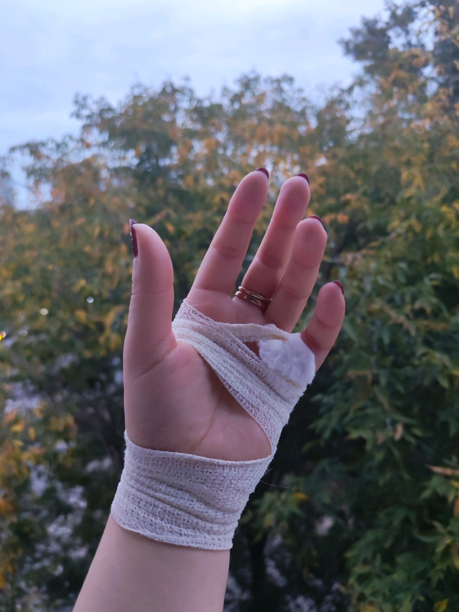 A close-up shot focuses on a person's left hand, which is bandaged from the wrist up to cover a portion of the palm. The hand has dark red nail polish on its fingernails and is adorned with two gold-colored rings on the ring finger. A small piece of white cotton material is visible on the back of the hand where it meets the bandage. The background consists of blurred trees with autumn foliage and a muted sky, suggesting an outdoor setting. The image does not provide any specific visual cues or landmarks that would place it in Izhevsk, Russia.