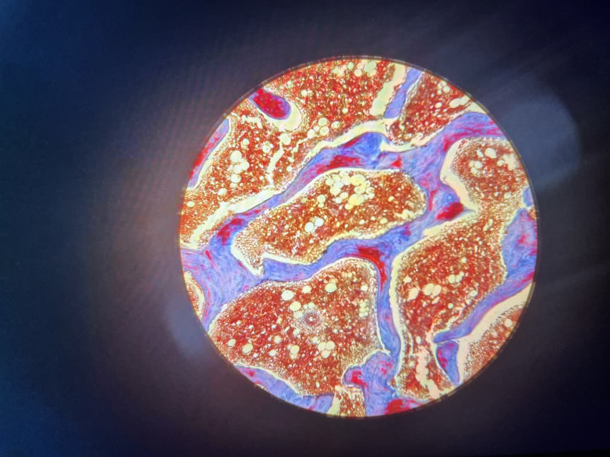 This is a microscopic image of bone marrow tissue. The tissue shows red and orange staining with numerous white, circular structures within. The surrounding area between the marrow areas is stained blue.
