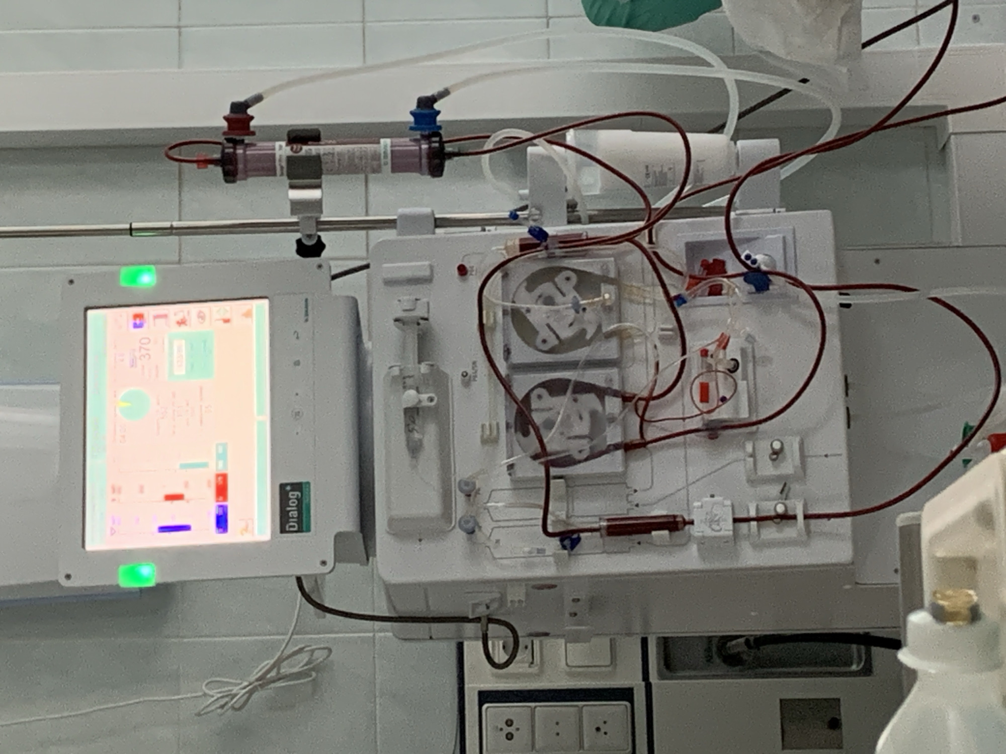 The image displays a close-up of a sophisticated medical machine operating in a clinical environment, likely a hospital or clinic in Chaikovsky, Russia. The central subject is a white, modern hemodialysis or apheresis machine, designed for filtering a patient's blood.
The machine features a large digital screen on its left, which is brightly lit and shows various readings, graphs, and colored indicators in red, blue, and green. A prominent green light glows on the lower left side of the screen, indicating the machine is active. The brand "Dialog" is clearly visible on the screen's right side, consistent with B. Braun's Dialog+ hemodialysis system. Numbers such as "370" are visible amidst other data points on the display.
To the right of the screen, the main body of the machine is intricate, with a network of translucent tubes. Many of these tubes are colored red, indicating pathways for blood, while clear tubes likely carry other solutions or waste. Several components are integrated into the system, including two circular peristaltic pumps, which move fluids through the tubing. At the top, a horizontal cylindrical device, typical of a dialyzer or plasmapheresis filter, is connected to the tubing system. Small, clear chambers containing red fluid (likely blood) are also seen within the tubing.
The background consists of a white tiled wall, common in sterile medical settings. Below the machine, part of a white power outlet with multiple sockets is visible. No people are present in the frame, but the operational state of the equipment implies an ongoing medical procedure involving a patient and medical staff. The lighting suggests an indoor, artificial light setting.