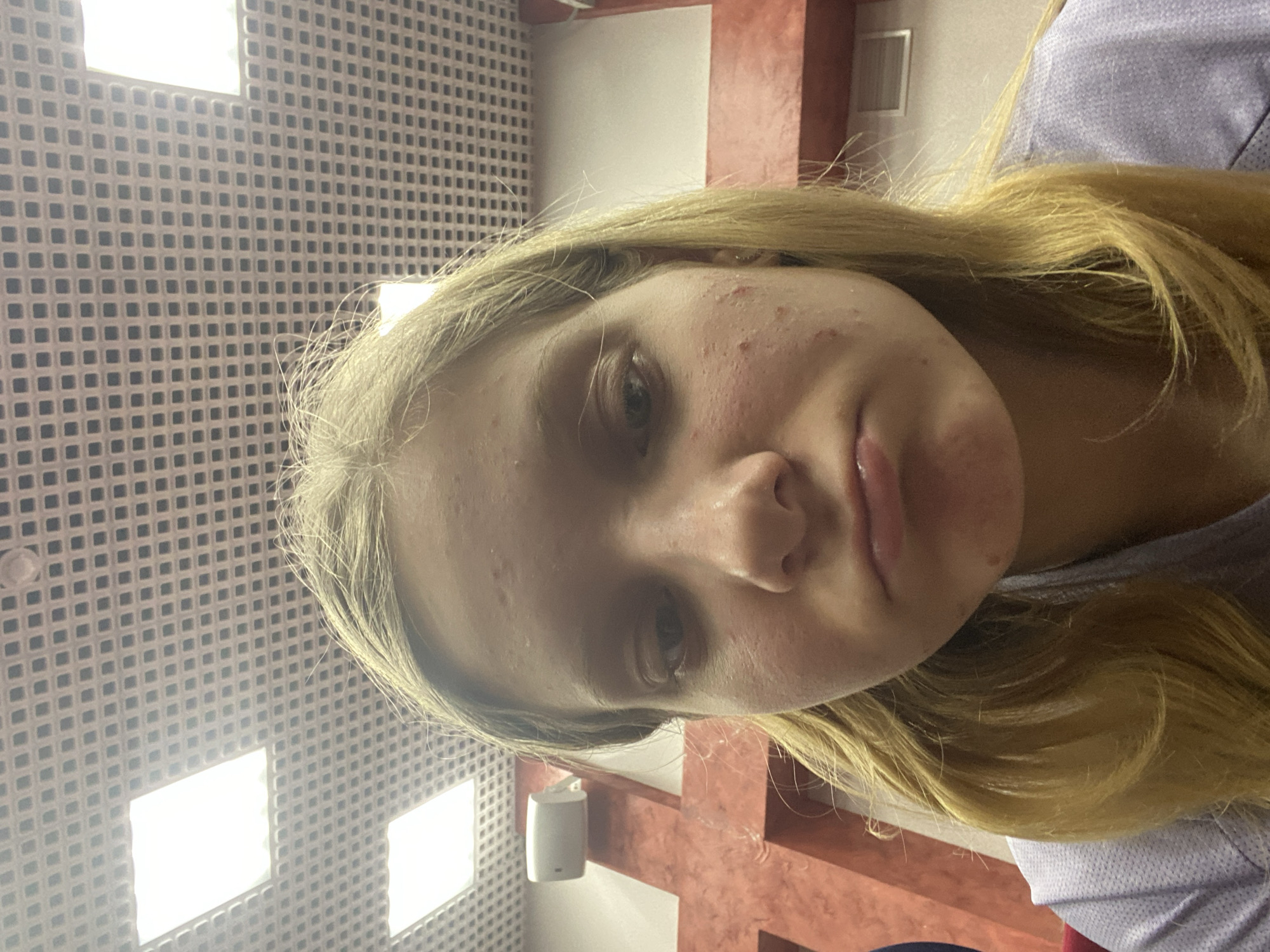 A close-up, slightly rotated selfie of a young, fair-skinned person with blonde hair. The person appears to have acne and red skin. They are wearing a light-colored shirt. The background shows an indoor location with a grid-patterned ceiling and recessed lighting. There are also some red painted walls and a white speaker on the wall. Location and specific city details are not discernable.