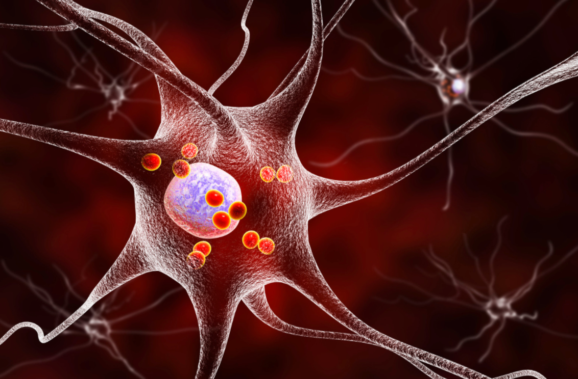 Alpha-synuclein fibrils may need inflammation to form Lewy bodies
