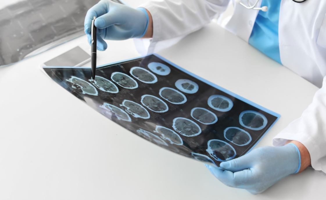 Amprion raises $6M to develop test for Parkinson’s disease
