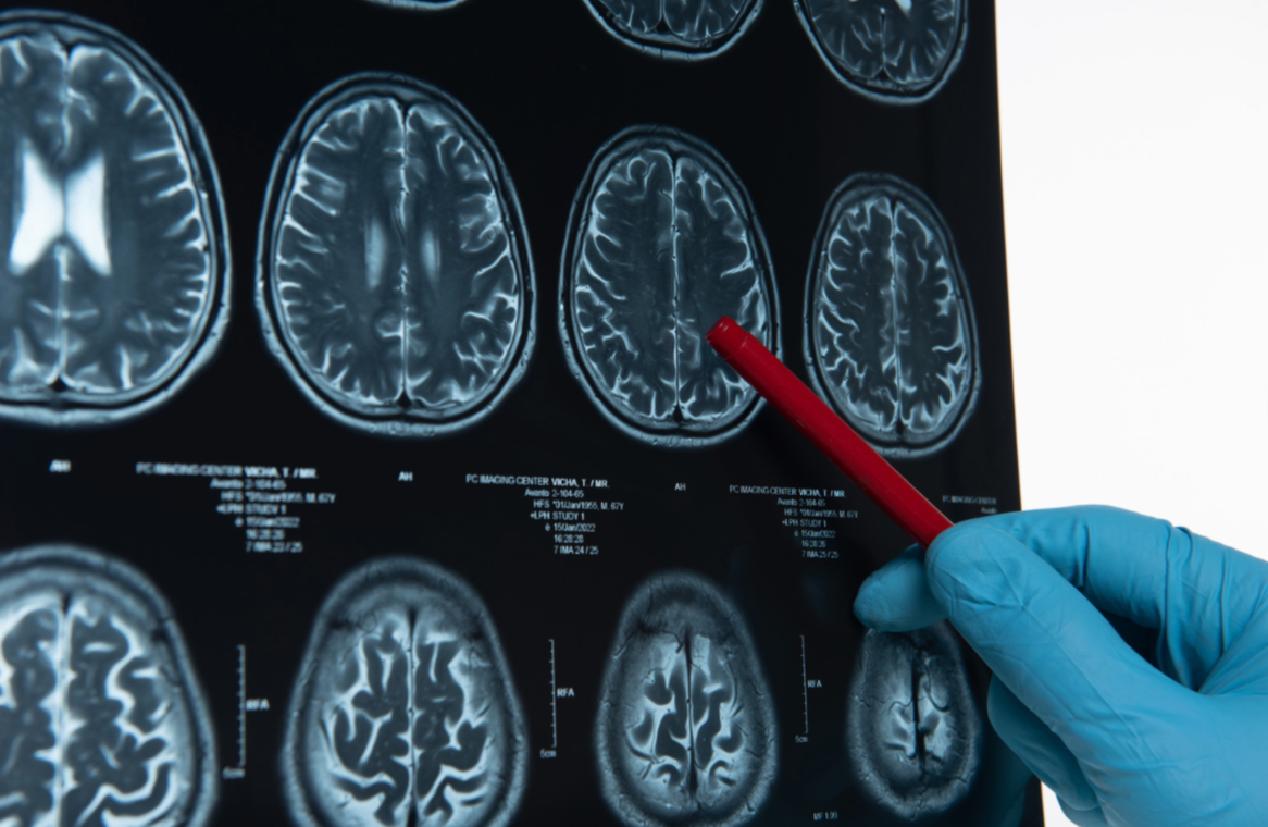 VIVOLTA Partners with Neurochase to Manufacture Micro-Catheters that Deliver Advanced Therapies to the Brain