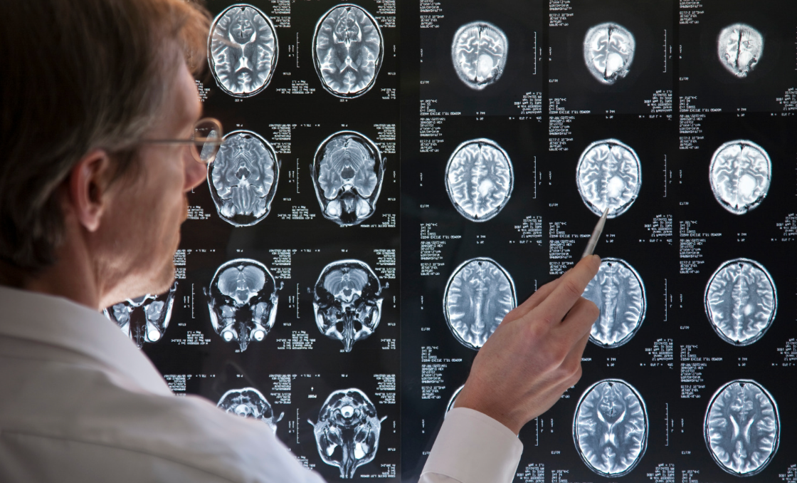 MRgFUS subthalamotomy in Parkinson’s disease: An approach aimed at minimizing Lesion Volume
