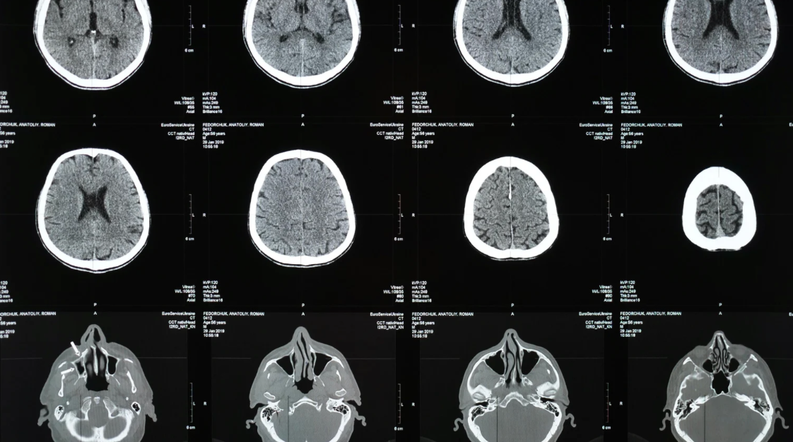 Tracer to diagnose Parkinson’s via PET scans moving into clinical trial