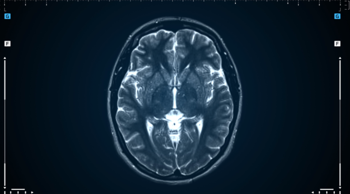 Deep brain stimulation halts Parkinson’s disease-related immune dysregulation in the brain and peripheral blood