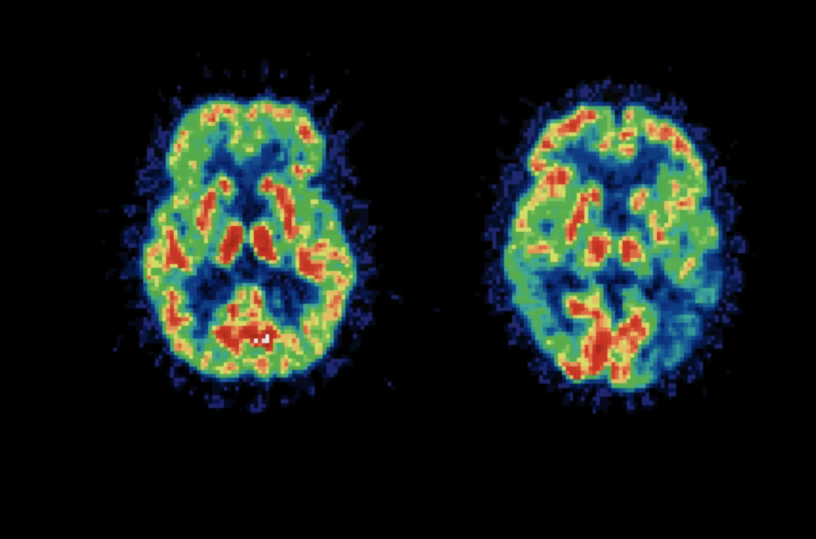 New Imaging Technology Aims to Advance Parkinson’s Research