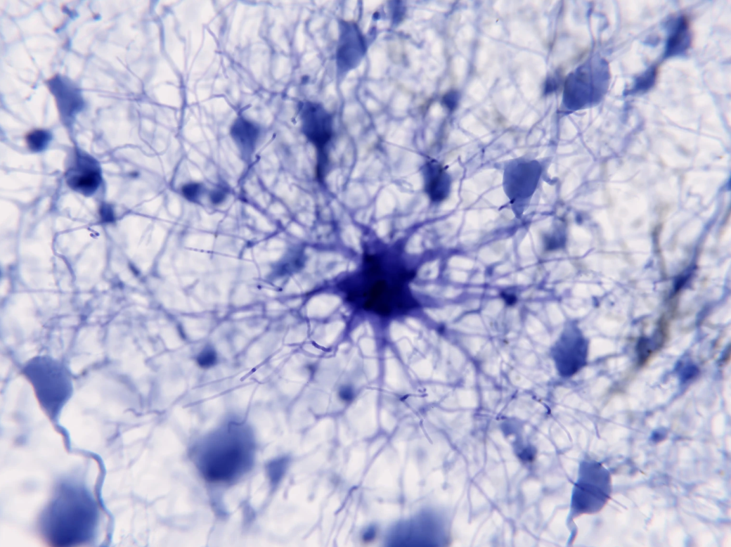 Inflammation: The Missing Link in Parkinson’s?