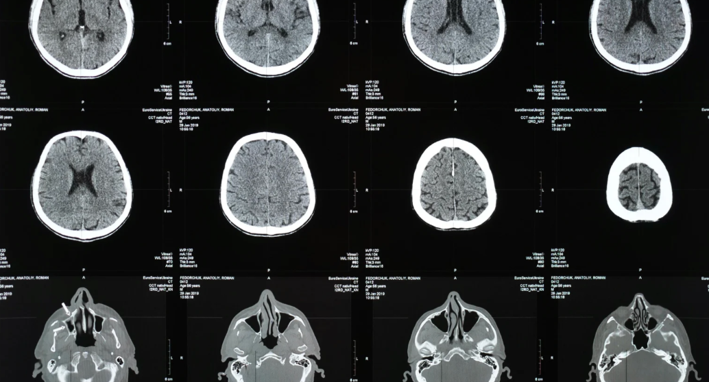 First Parkinson’s patient dosed in Phase 2/3 clinical trial of BHV-8000