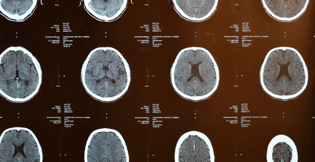Advanced Treatment for Parkinson’s Offers Better Quality of Life