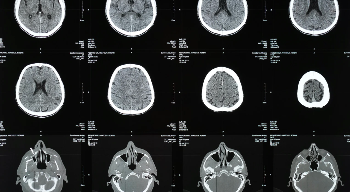 Fighting Brain Inflammation in Parkinson’s