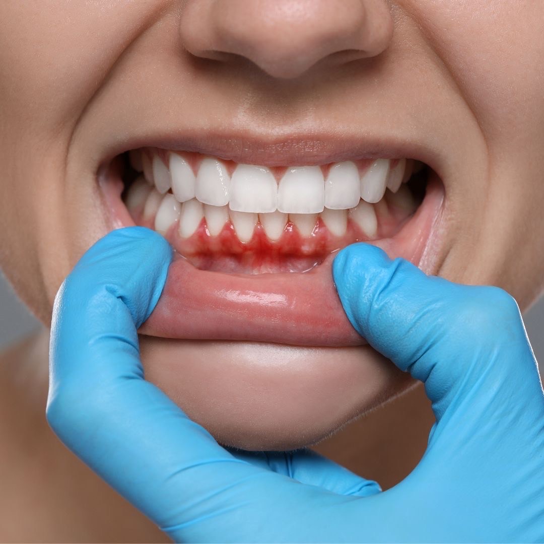 Possible link between long-term gum disease and Parkinson's disease