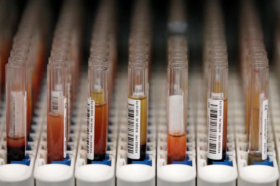 Higher-than-expected rate of gene mutations seen in Parkinson's patients