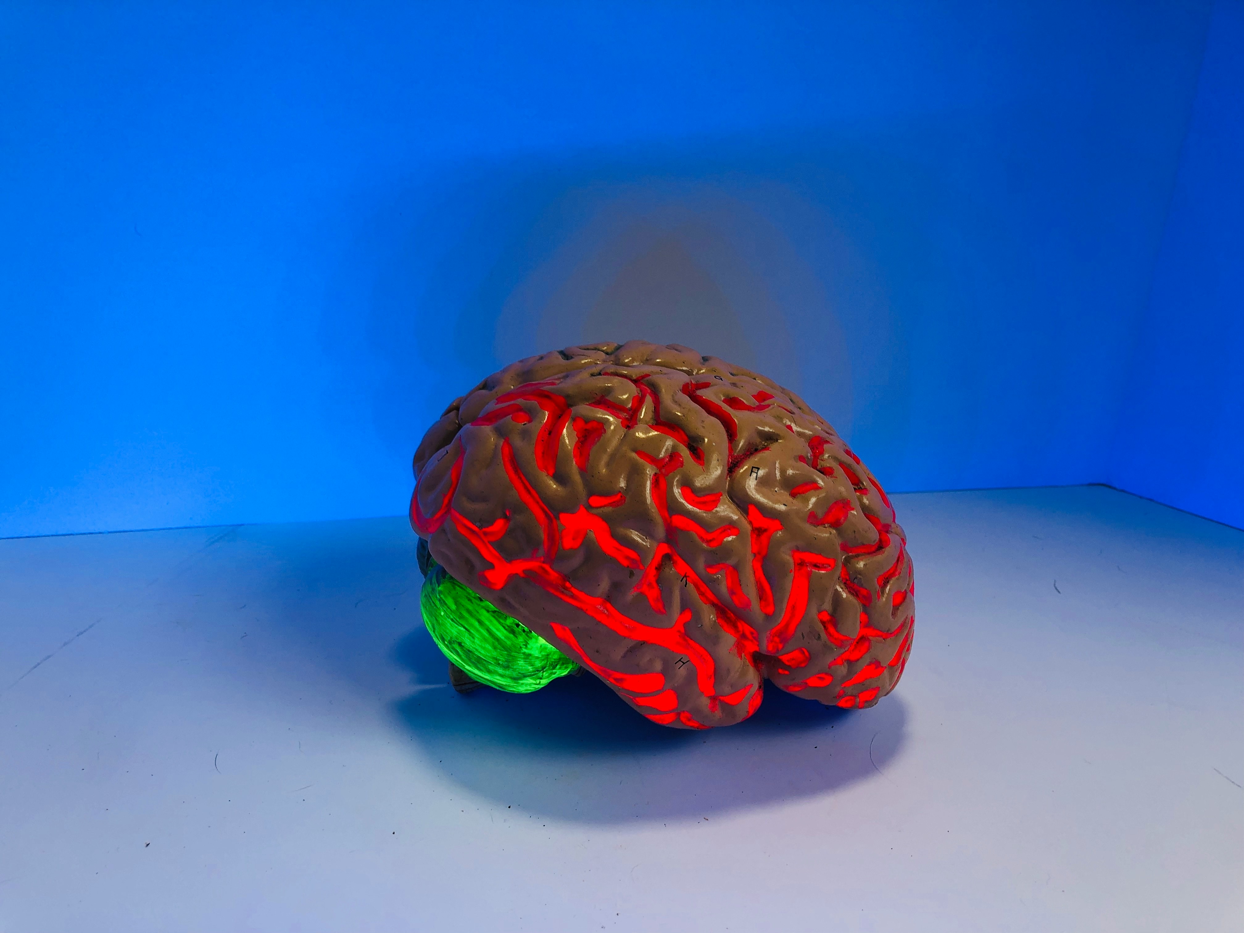 A global study on changes in the brain's white matter in people with Parkinson's disease