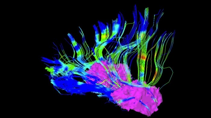 Implants reduce Parkinson’s symptoms by reading brain activity