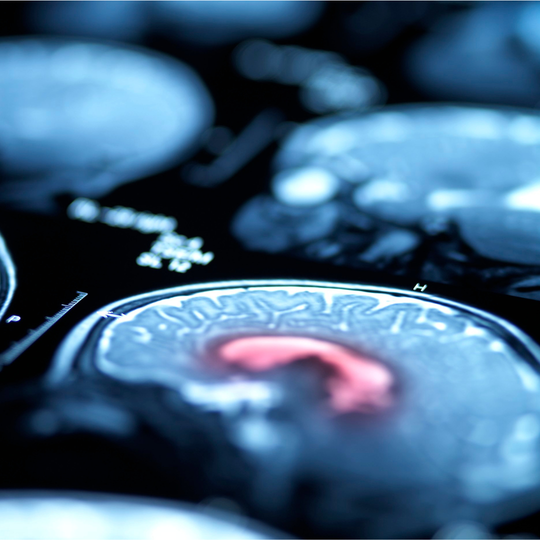 Brain Stimulation Reveals Occipital Region Activity in Parkinson's Patients Diagnosed Within the Last 5 Years