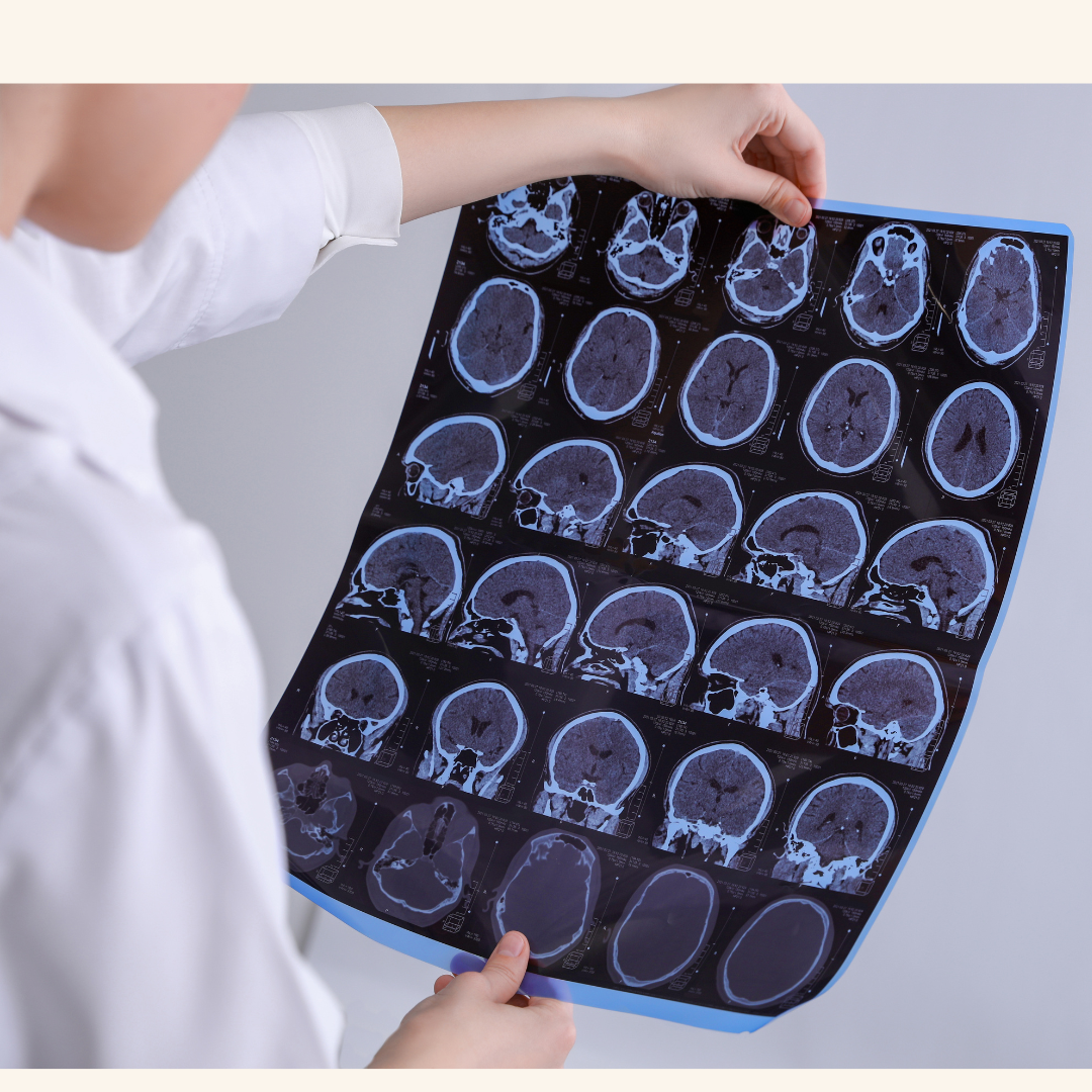 Disease-modifying therapies for Parkinson disease: lessons from multiple sclerosis