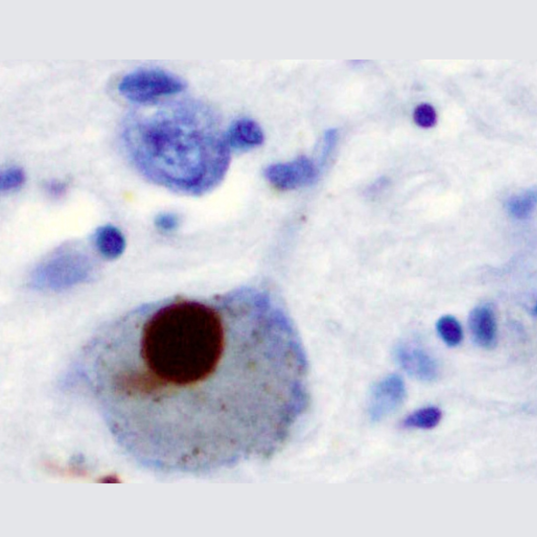 New Hope for Parkinson’s: Cancer Drug Shows Promise in Blocking Harmful Protein Spread