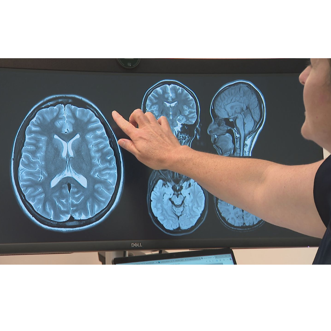 World-first trial to understand link between violent dreams and Parkinson's disease