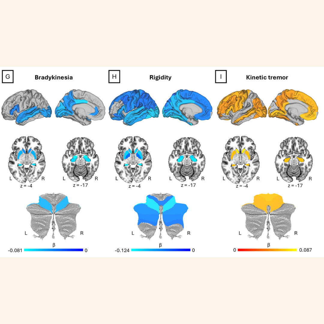 How Brain Changes Shape Parkinson’s Symptoms Over Time