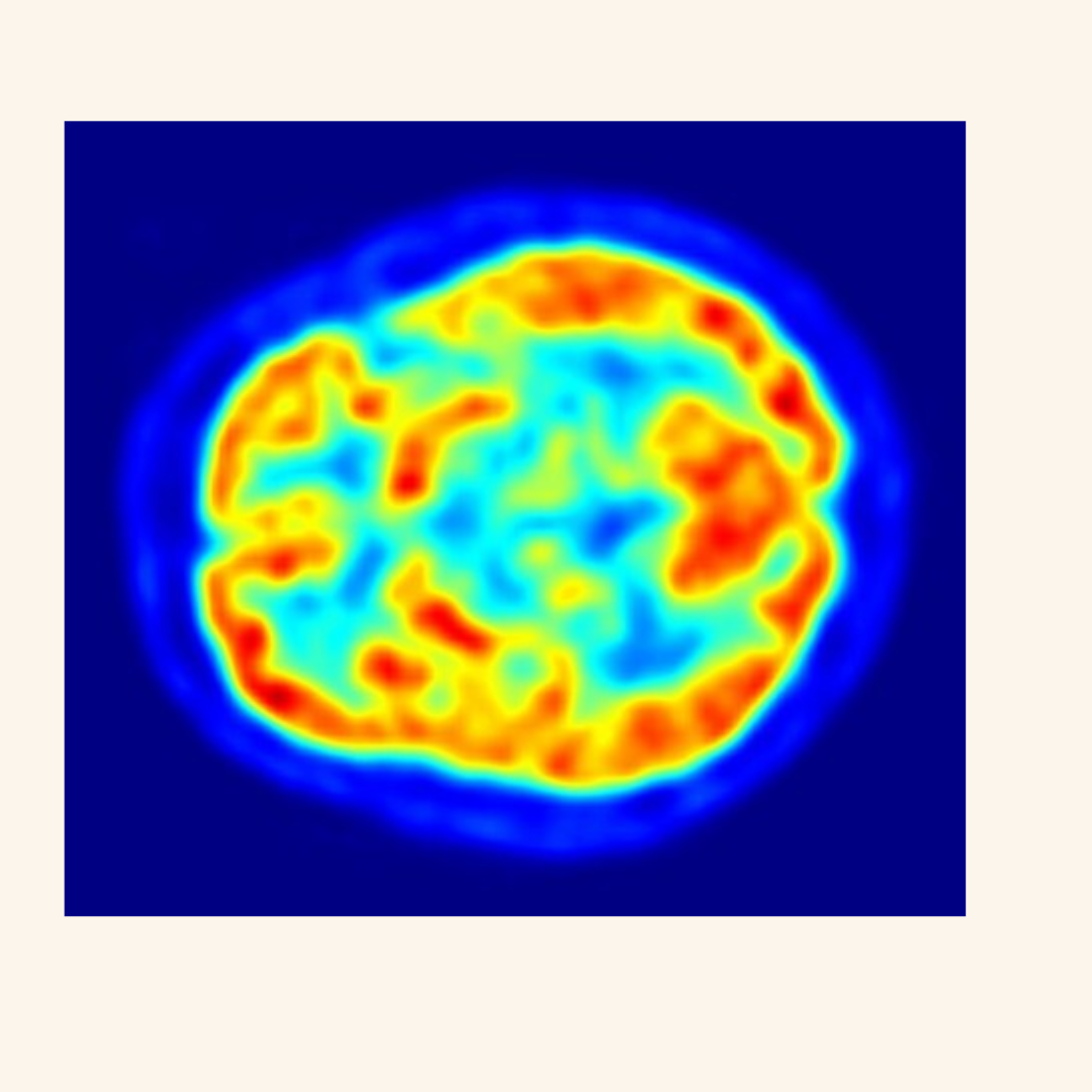 New Study Reveals How Brain Changes Can Help Identify Parkinson’s Disease Stages