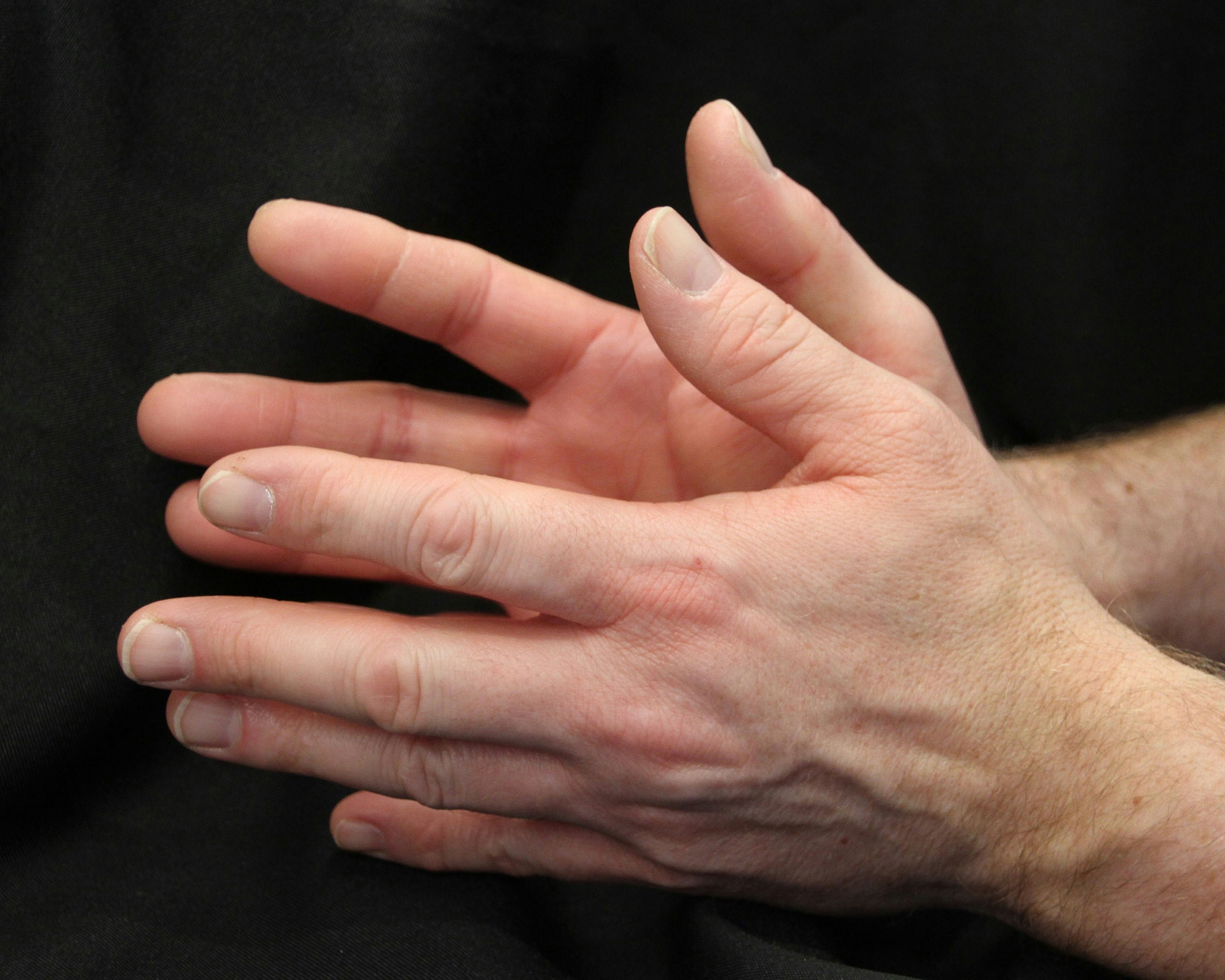Parkinson’s disease tremor explained by reflex loop changes