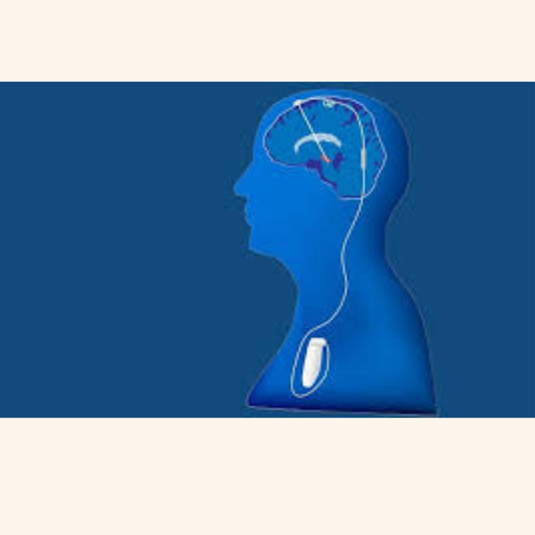 Updates on Deep Brain Stimulation, including adaptive DBS