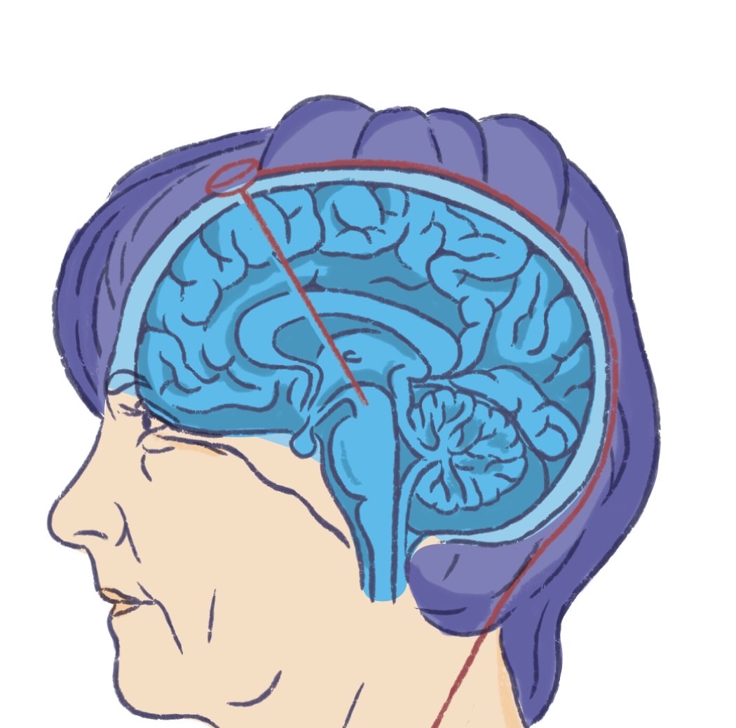 French Team’s Light Therapy Offers New Hope for Slowing Parkinson’s