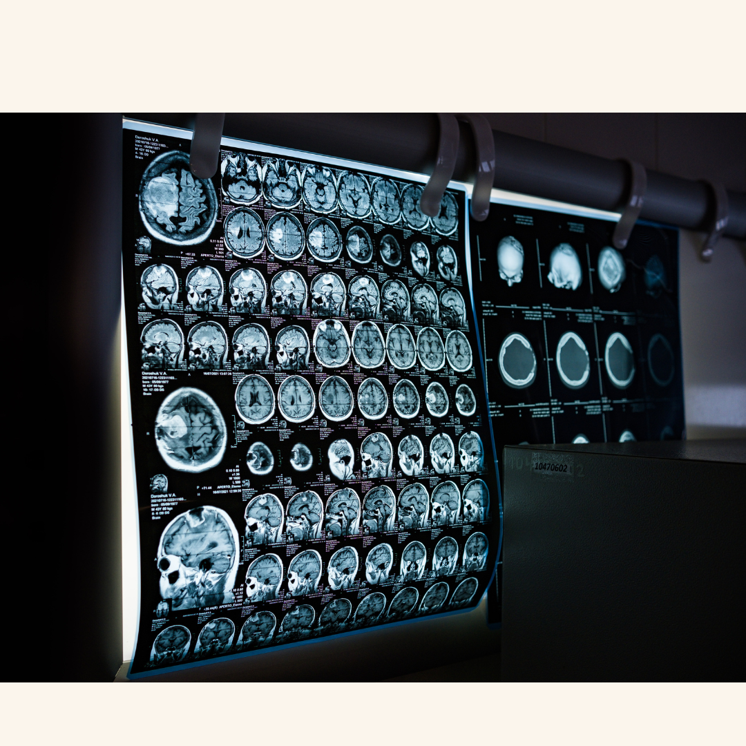 Can Brain Scans Help Predict How Parkinson’s Will Progress?
