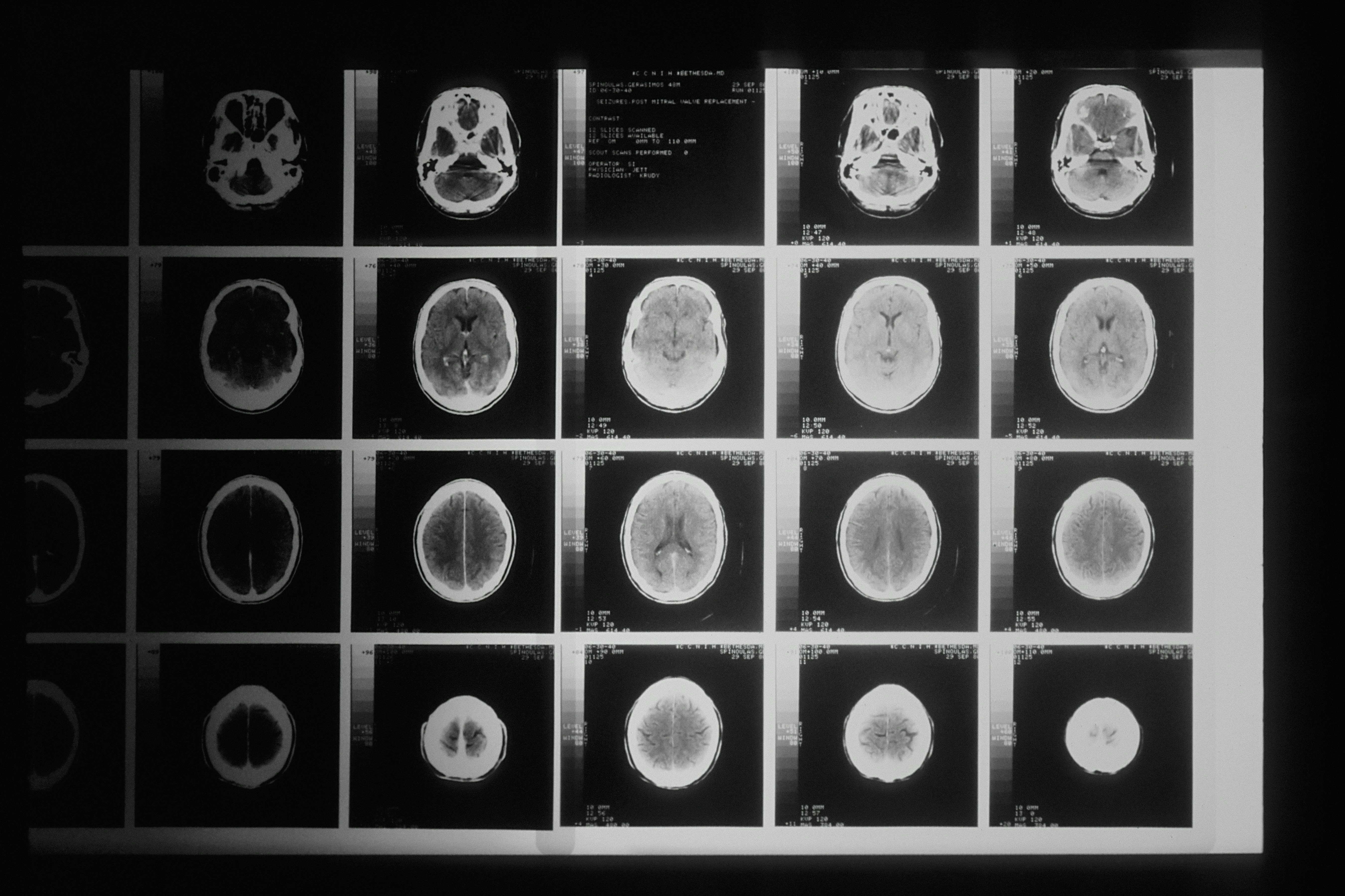 Stopping the Spark: Could New Treatments Block the Toxic Alpha-Synuclein in Parkinson’s?