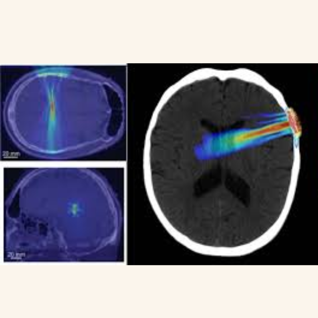 A New Direction for Parkinson’s Treatment: Focused Ultrasound Tractotomy