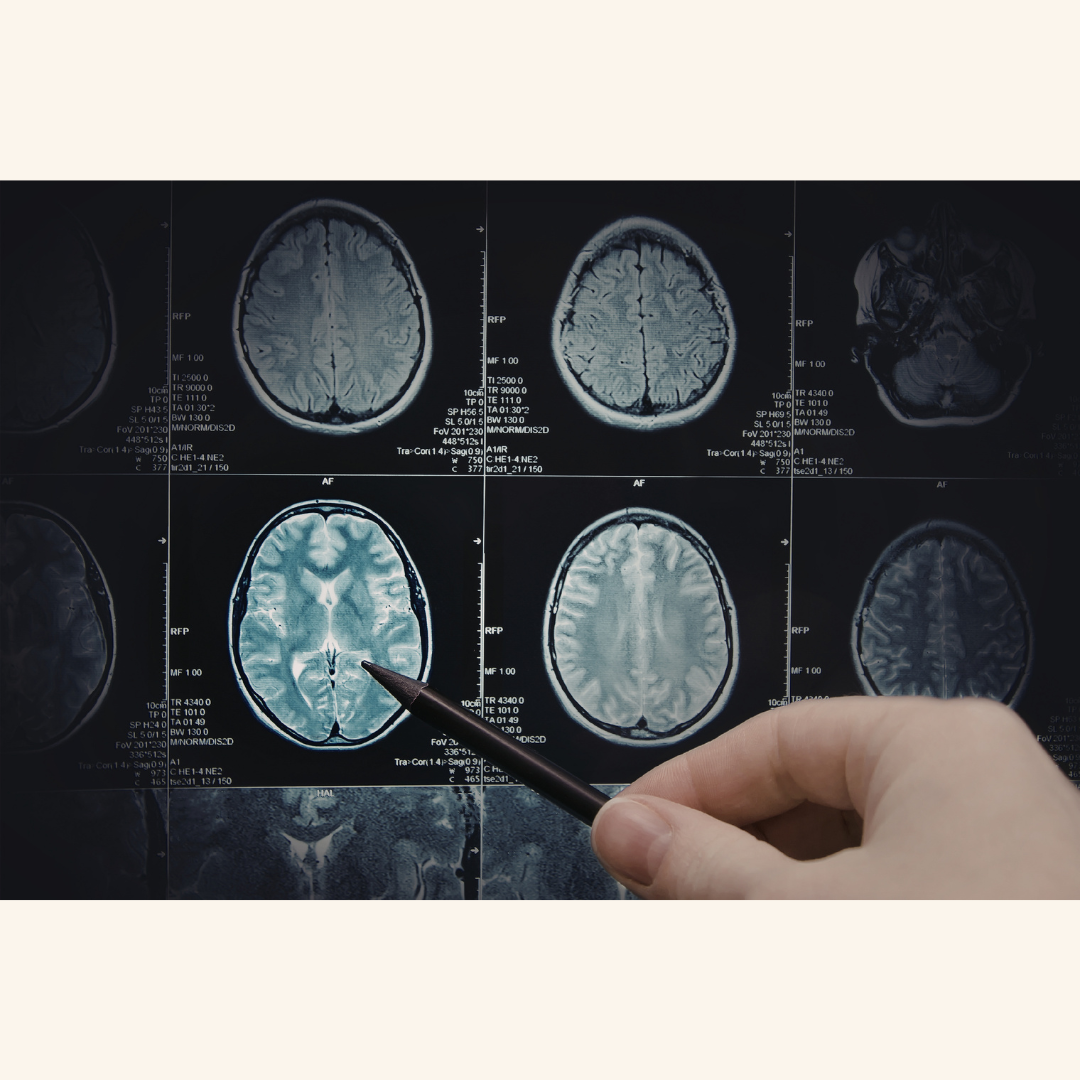 UHS Wilson Medical Center Reaches Milestone with 100th Focused Ultrasound Procedure for Tremor