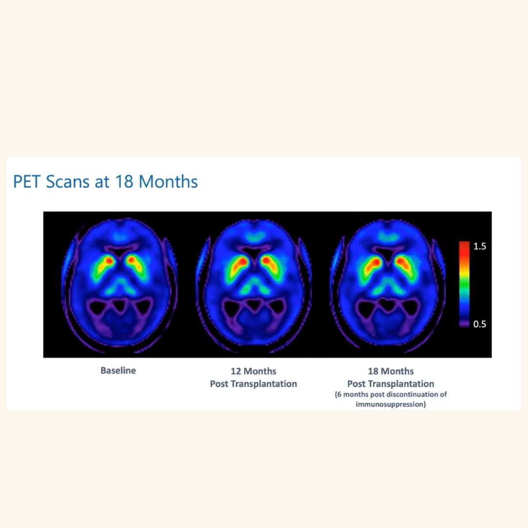 Stem Cell Therapies for Parkinson’s: Dr. Gilbert Hosts - Are We Finally on the Verge of a Breakthrough?