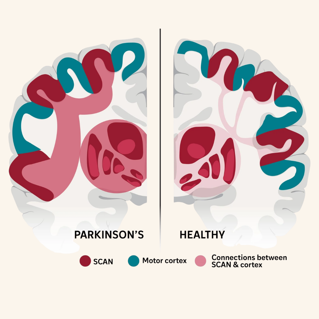 New Brain Map Reveals the "True Source" of Parkinson's May Be a Network Glitch