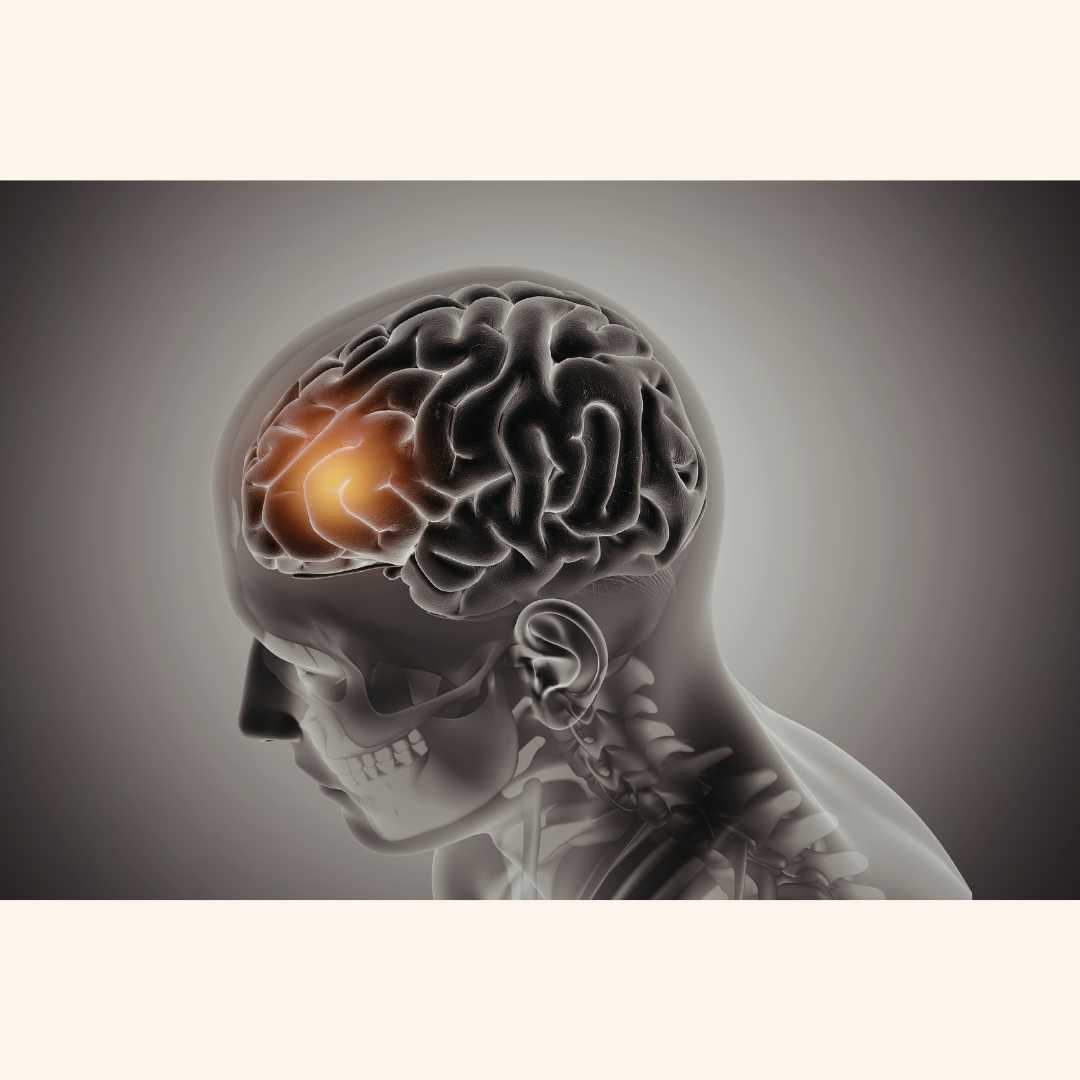 Unexpected Relief: Brain Bleed Stops Hallucinations for Man with Parkinson's