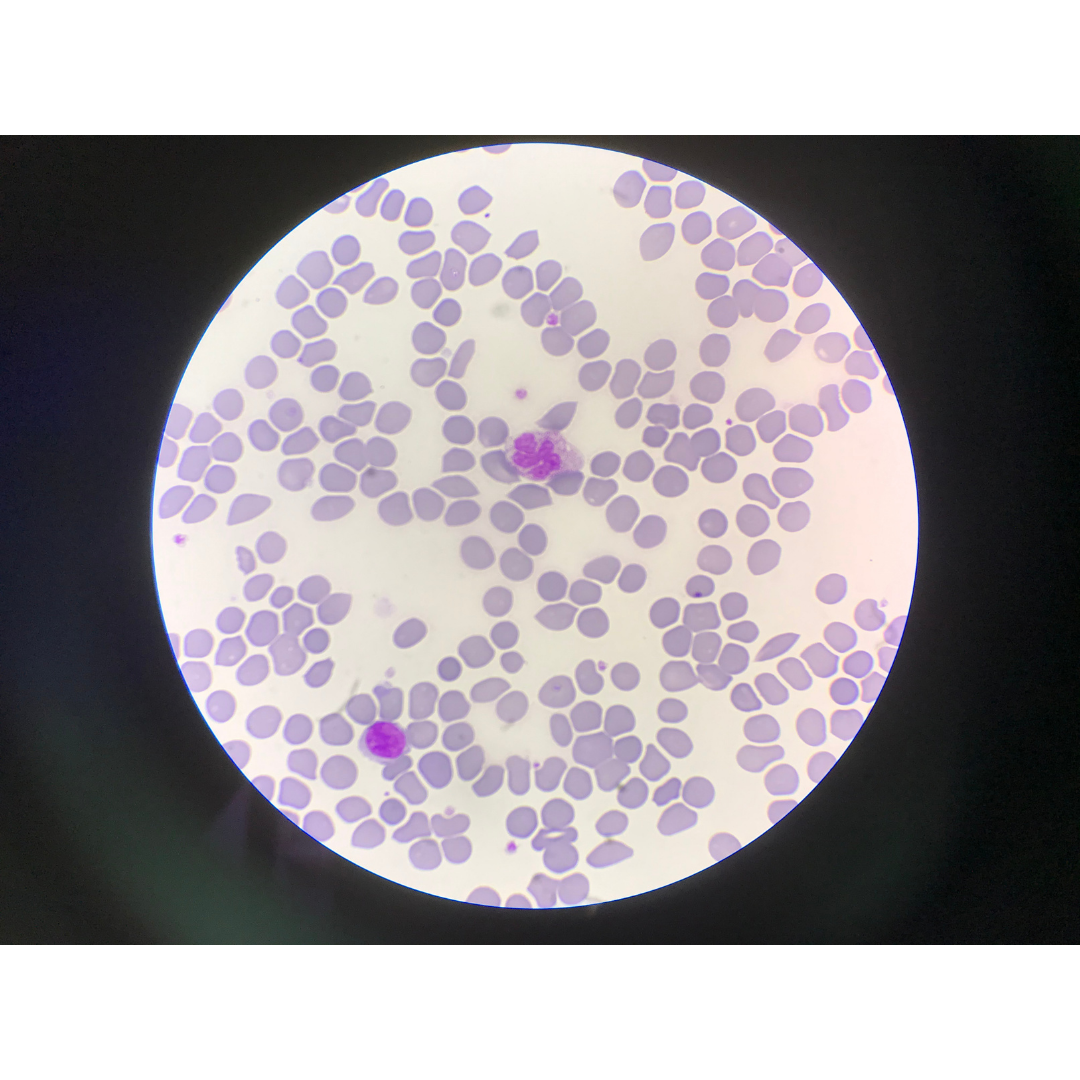 Aspen Neuroscience Reports Breakthrough 12-Month Results in Personalised Stem Cell Trial