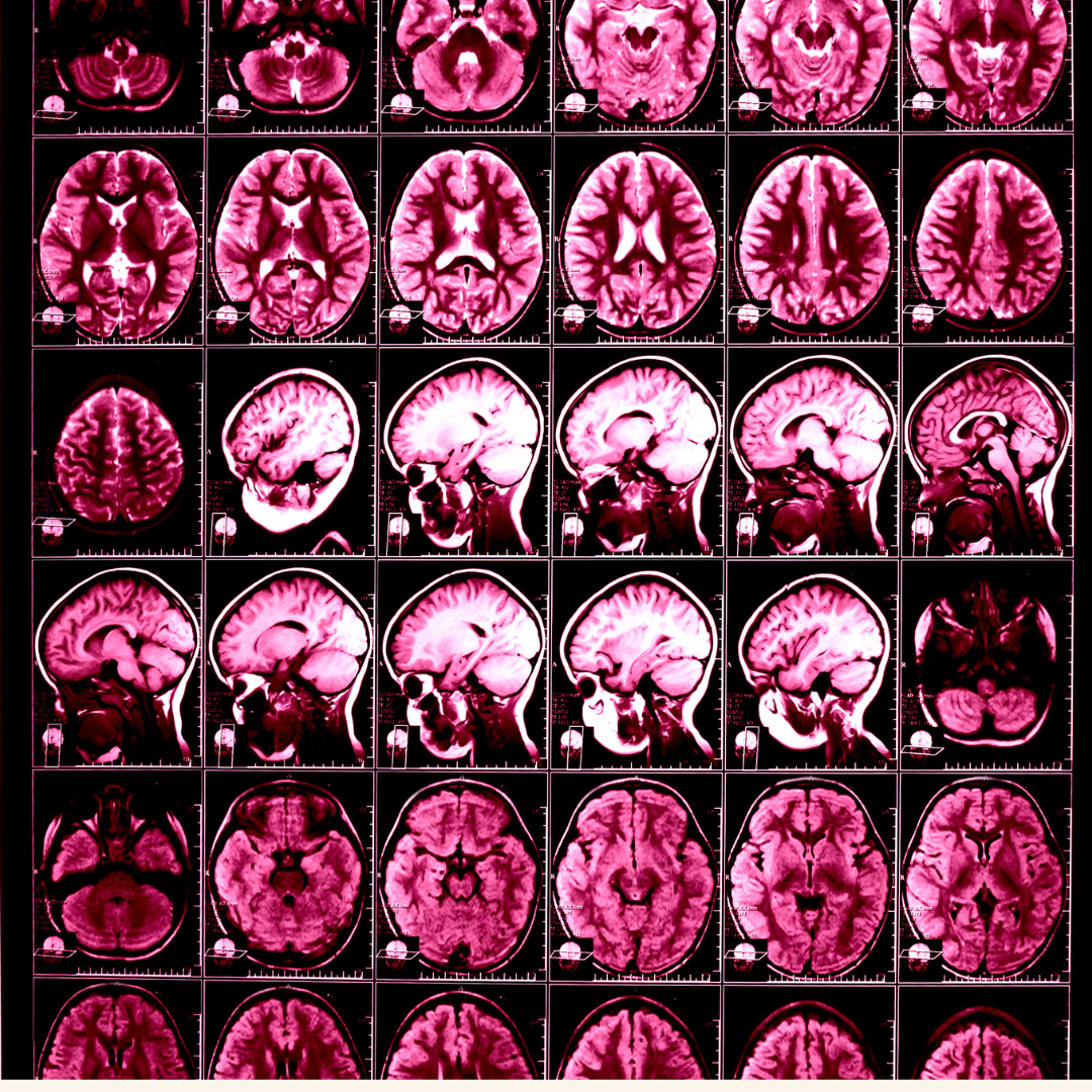 Moving the Target: How a New Brain Site Improves Focused Ultrasound for Parkinson’s