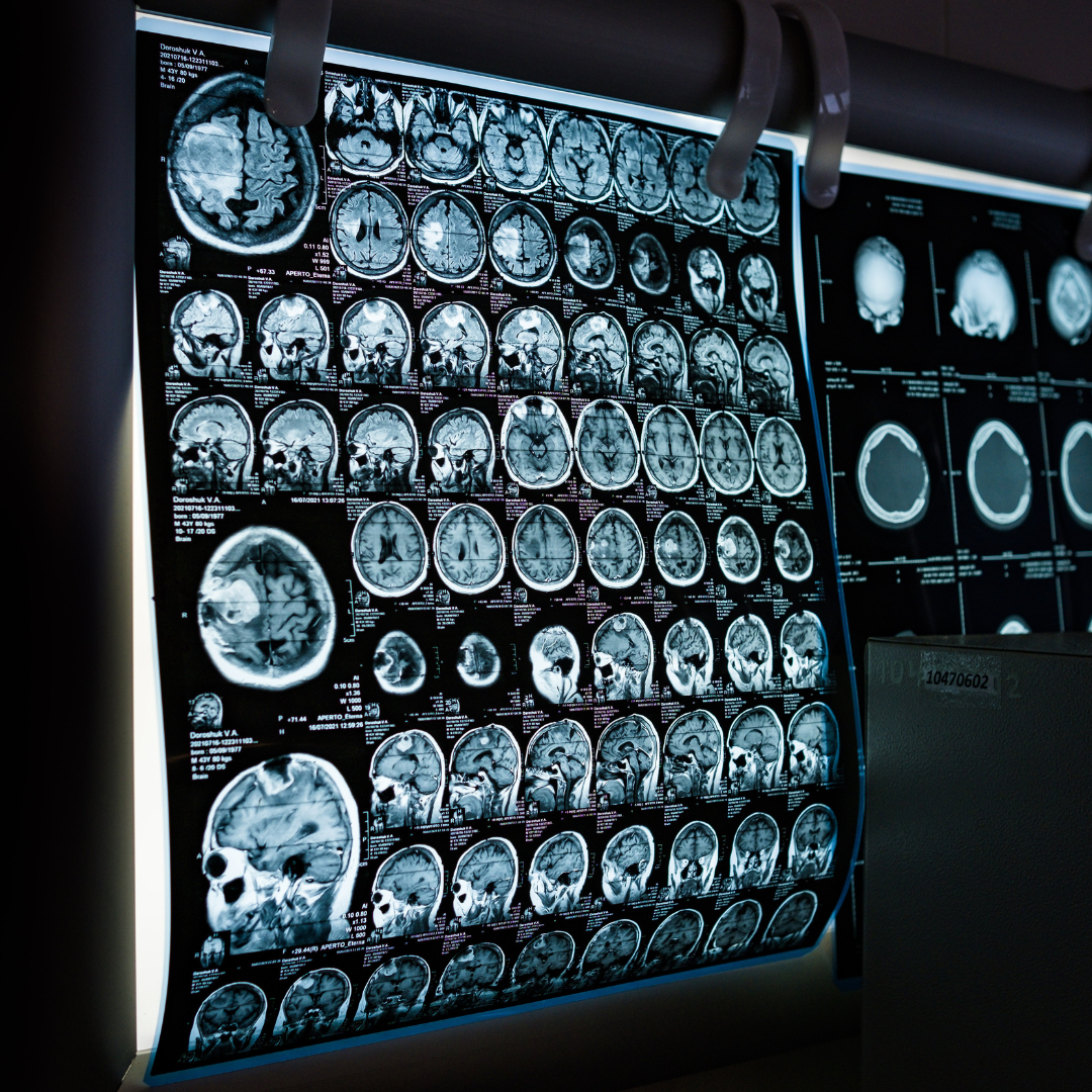 Smart brain implants can now track walking difficulties by learning from other people with Parkinson's
