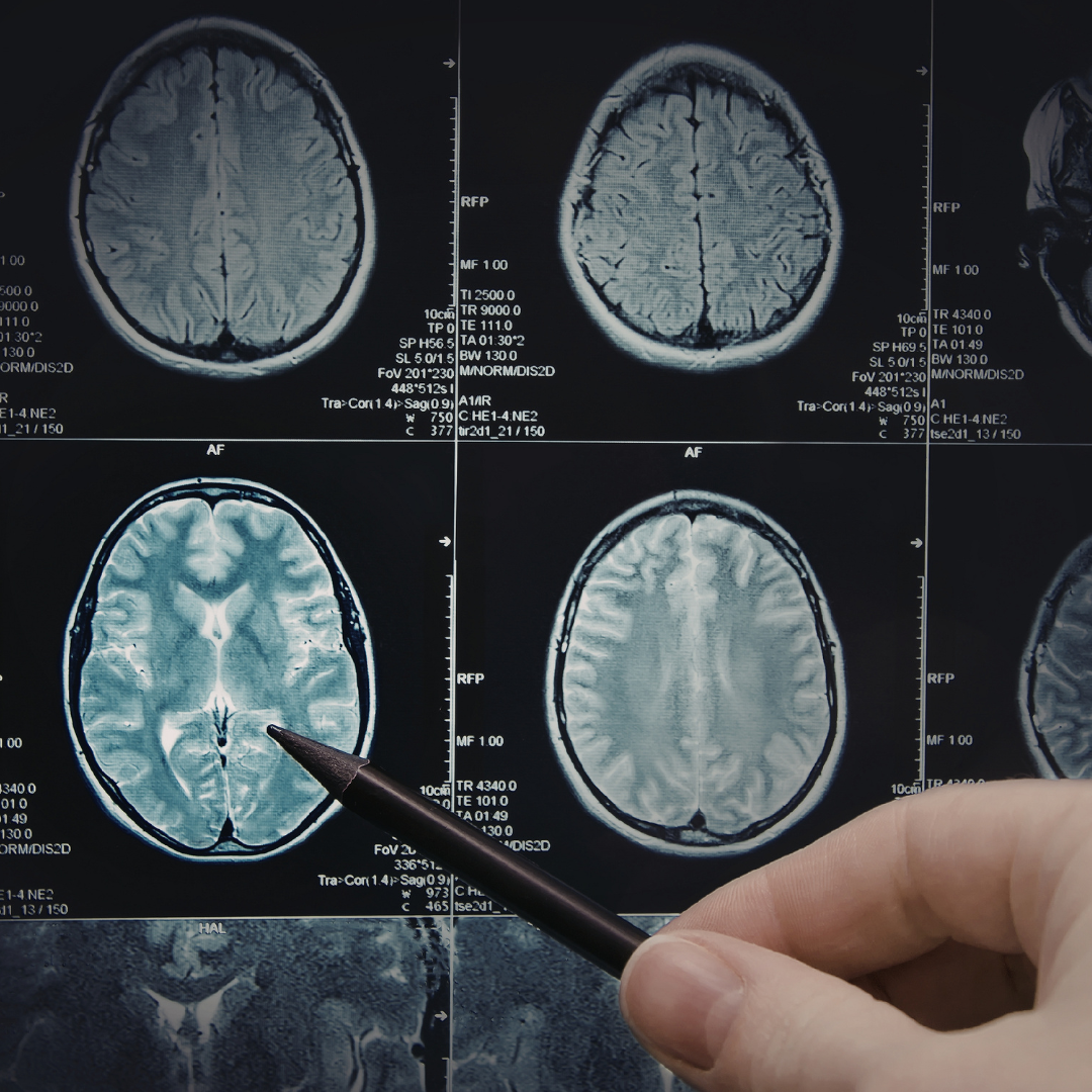 Brain scans reveal how damaged wiring leads to memory and thinking changes in Parkinson's