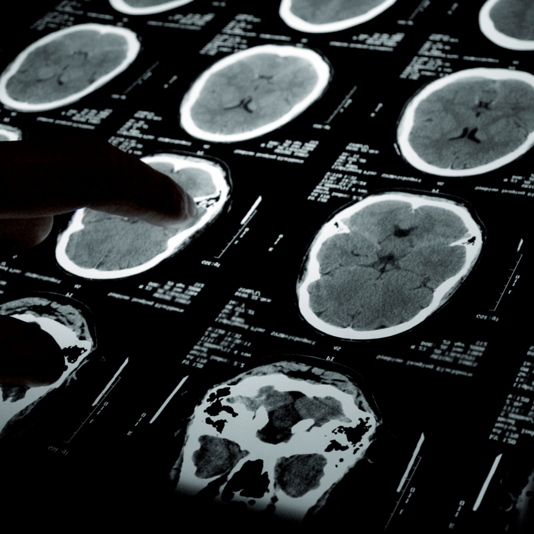 How your movement pattern in Parkinson's acts as an early roadmap for sleep, mood, and daily energy