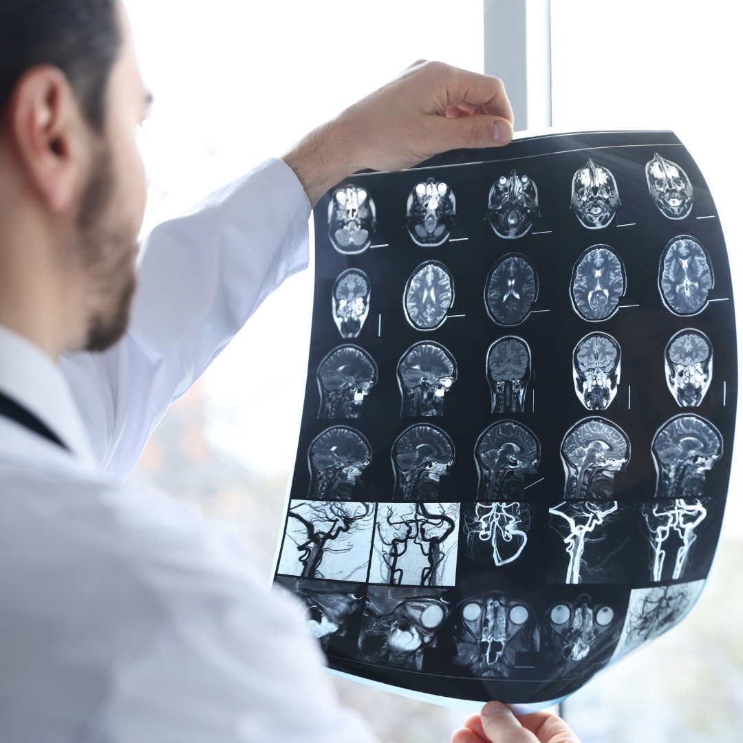 A September 2026 review finds smart brain stimulation does not outperform standard therapy for slowness in Parkinson's