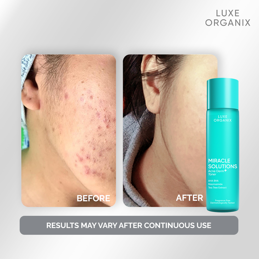 Luxe Organix, Miracle Solutions Acne derm Toner 150ml